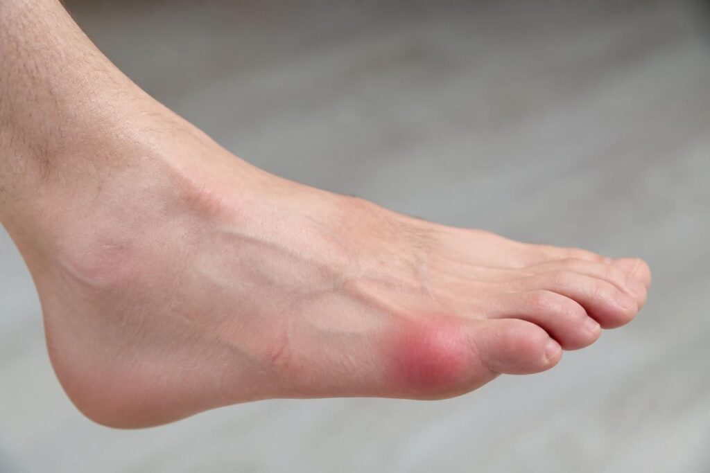 découvrez comment reconnaître les symptômes de la bursite au pied pour prévenir une douleur chronique et retrouver votre confort au quotidien.